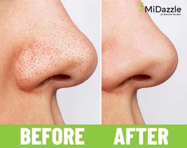 Midazzle Blackhead Remover-Round M79 Mibr3301- QBH1033 - Image 5